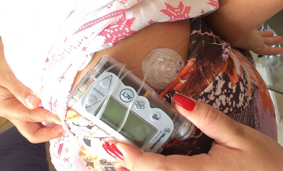 Estudante é impedida de fazer Enem por uso de bomba de insulina