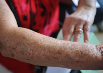 Manchas podem ser sinal de câncer de pele