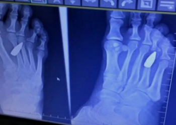 Mulher sente dor no pé e descobre que foi atingida por fuzil na noite de réveillon no RJ