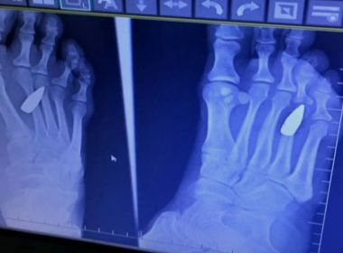 Mulher sente dor no pé e descobre que foi atingida por fuzil na noite de réveillon no RJ