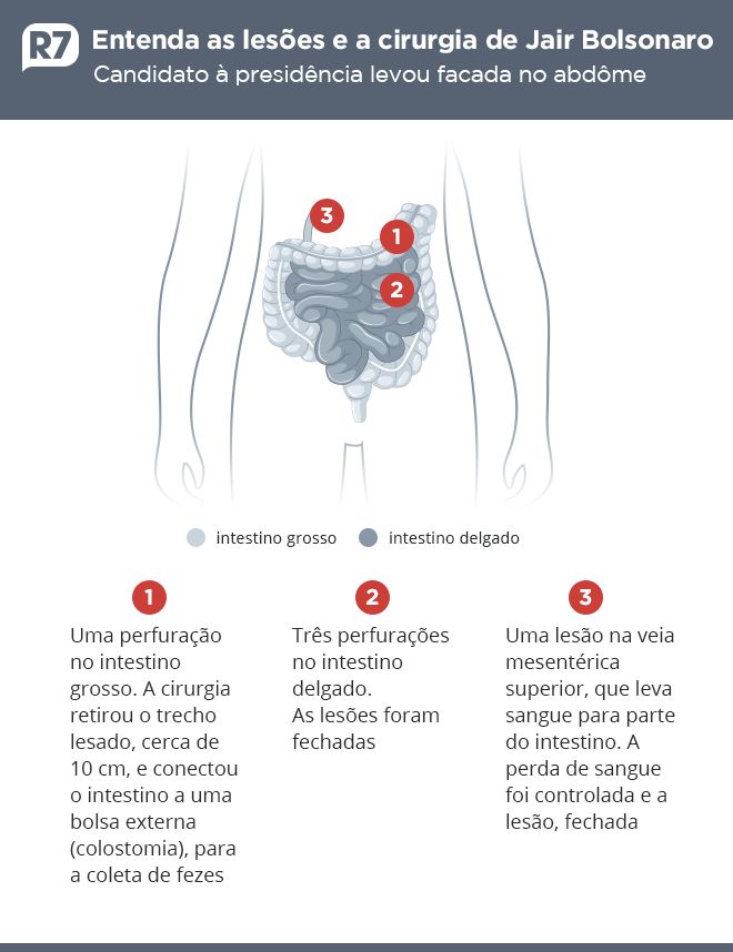 Entenda por que não havia sangue após a facada em Bolsonaro