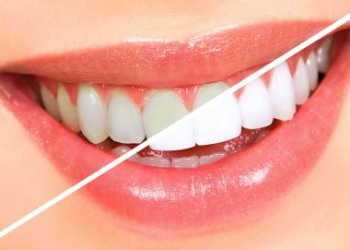 TJ-BA pagará quase R$ 39 mil por kits de clareamento dental para servidores e juízes