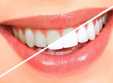 TJ-BA pagará quase R$ 39 mil por kits de clareamento dental para servidores e juízes