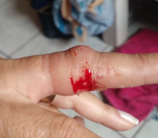 Acusado de arrancar aliança de vítima com a boca durante assalto é baleado; ele confessou o crime