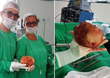 Jacobina: pedra de 1,3 kg é retirada de bexiga de paciente