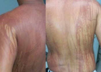 Turista fica com manchas no corpo após banho de mar no sul da Bahia