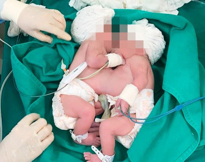 Soteropolitana dá a luz a gêmeas siamesas nesta quinta-feira (29)