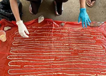 Idoso vai a hospital com dor de estômago e descobre verme de 18 metros em seu reto