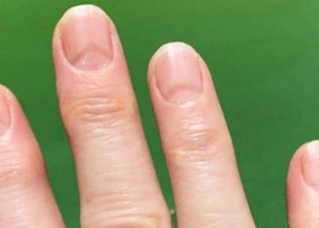 Marcas nas unhas podem indicar se você já pegou covid-19; entenda