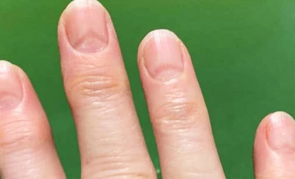 Marcas nas unhas podem indicar se você já pegou covid-19; entenda