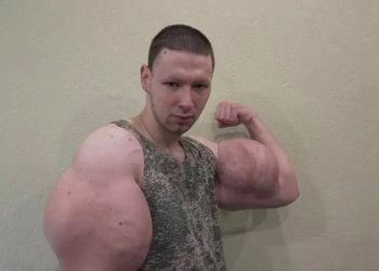 ‘Popeye’ russo passa por cirurgias após bíceps ‘explodir’ e corre risco de morrer
