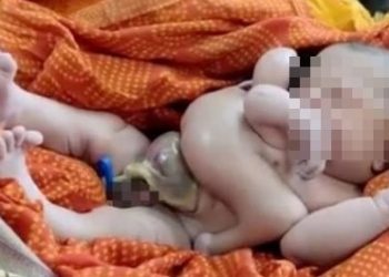 Índia – Bebê nascido com quatro braços e quatro pernas é tratado como divindade