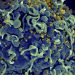 Primeira mulher declarada curada do HIV após transplante de células-tronco