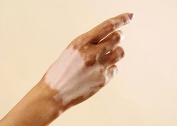 Com causa indefinida, vitiligo atinge cerca de 1 milhão de brasileiros