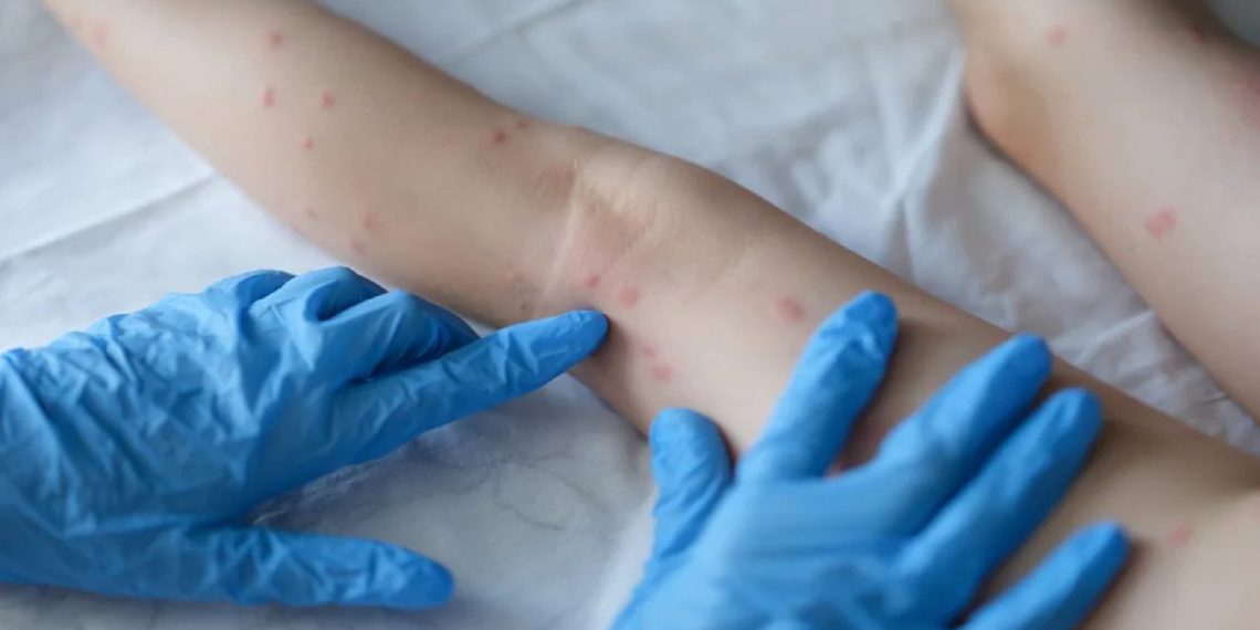 Secretaria de Saúde de Coité monitora caso suspeito de Varíola do Macaco