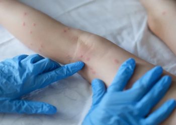 Secretaria de Saúde de Coité monitora caso suspeito de Varíola do Macaco