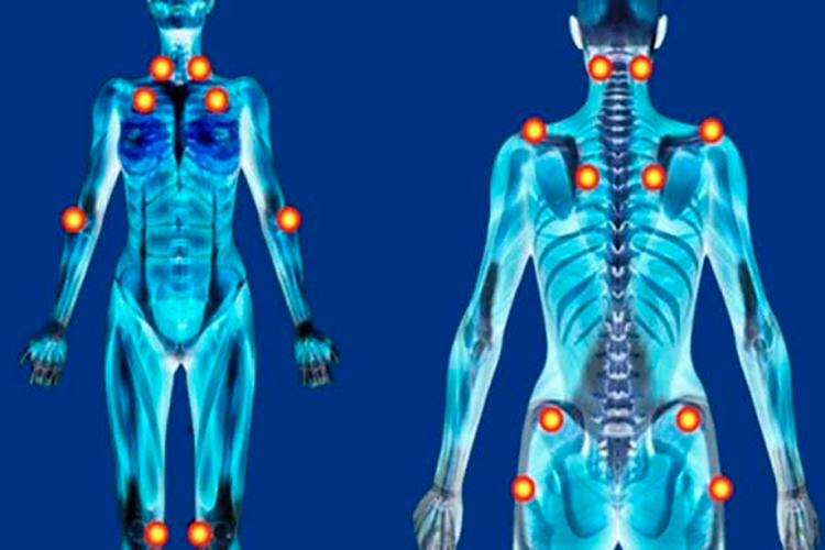Projeto define fibromialgia como deficiência para todos os efeitos legais