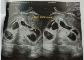 ES – Mãe descobre que está grávida de sêxtuplos : ‘Fui na consulta só para ver 1 bebê e descobri 6’