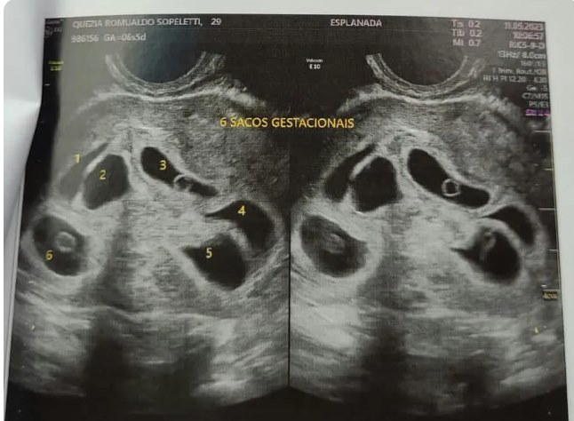 ES – Mãe descobre que está grávida de sêxtuplos : ‘Fui na consulta só para ver 1 bebê e descobri 6’