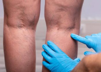 13 de Outubro – Dia Mundial da Trombose: Bahia é estado com maior número de amputações do Nordeste e registra aumento de óbitos pela doença