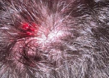 RJ – Estudante é atingido por bala perdida na cabeça e só descobre 4 dias depois: ‘Achei que fosse pedrada’