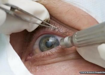 Médicos alertam para riscos de cirurgia de mudança da cor dos olhos