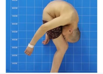 Após 28 anos andando ‘dobrado’, homem faz cirurgia e consegue andar ereto pela primeira vez