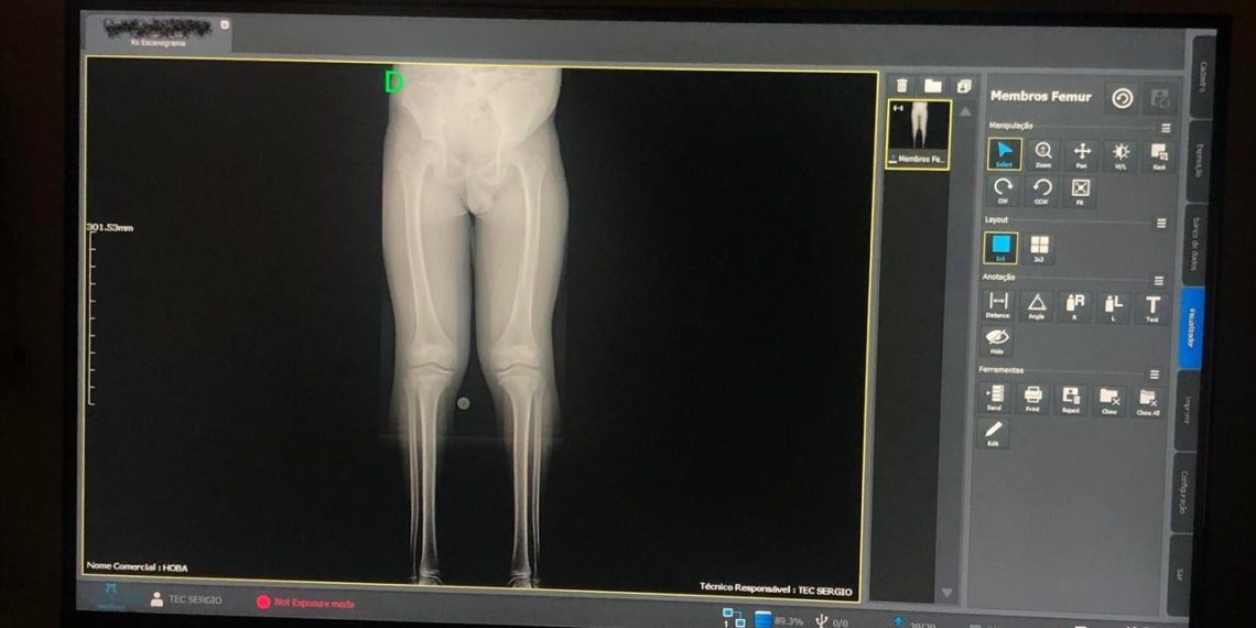 Hospital Ortopédico do Estado da Bahia disponibiliza exame inédito no SUS para diagnóstico de alterações ósseas