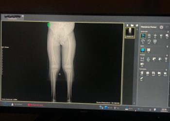 Hospital Ortopédico do Estado da Bahia disponibiliza exame inédito no SUS para diagnóstico de alterações ósseas