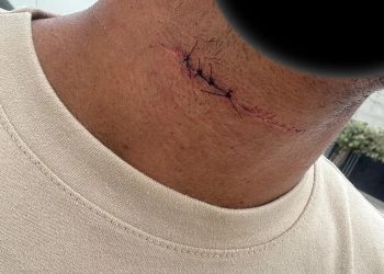 Linha com cerol quase decepa pescoço de estudante de Direito no dia da formatura