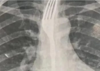 Mulher engole garfo durante refeição