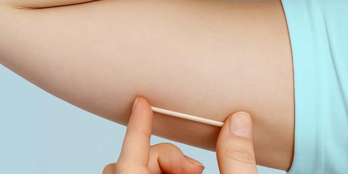 Implante contraceptivo deve ser ofertado por planos a partir de hoje