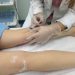 Barrocas oferta tratamento clínico de varizes por espuma e amplia acesso da população a atendimento vascular