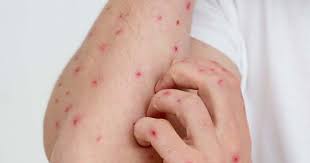 Brasil registra 88 casos de Mpox em 2026; saiba como evitar a doença